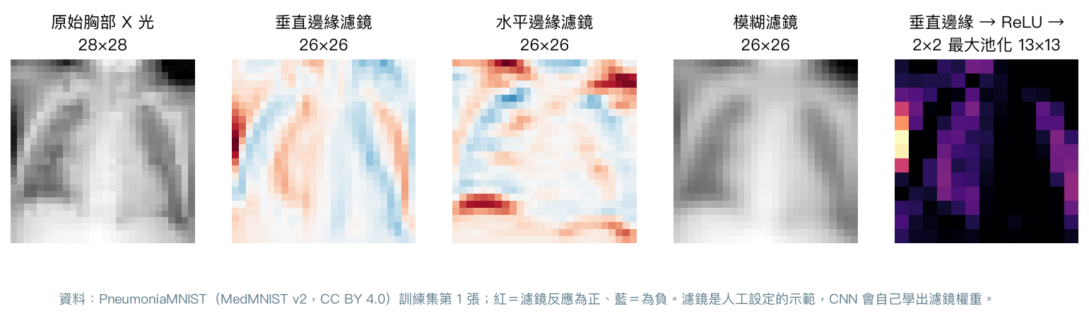 一張 28×28 胸部 X 光分別經過垂直邊緣、水平邊緣、模糊濾鏡,以及垂直邊緣加 ReLU 再加 2×2 最大池化的結果