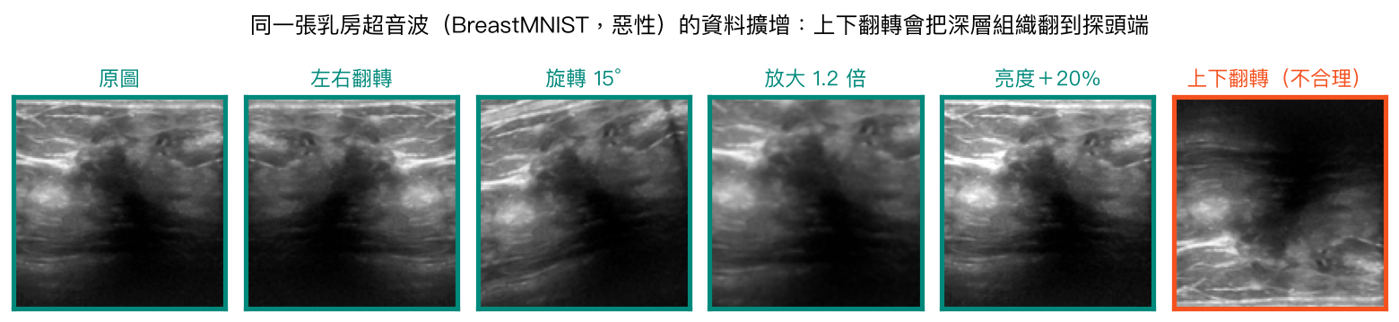 同一張乳房超音波的六種擴增：綠框合理，橘框的上下翻轉不合理