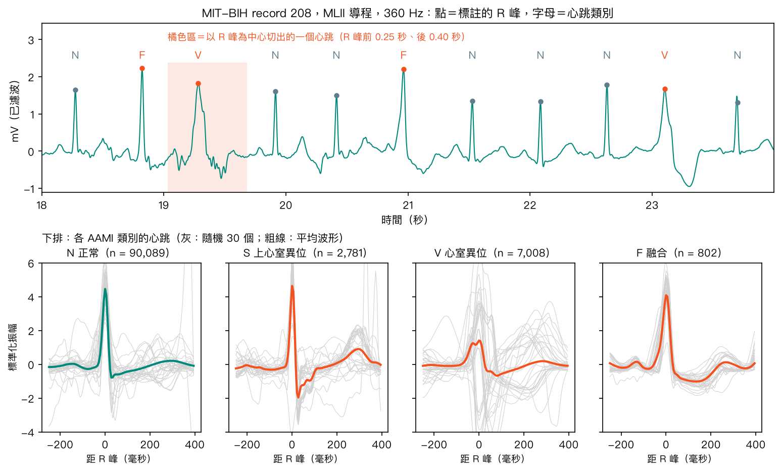上：record 208 的 6 秒心電圖，點是標註的 R 峰、字母是心跳類別，橘色區是切出的一個心跳；下：四個 AAMI 類別各 30 個心跳（灰）與平均波形（粗線）